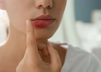 Herpes labial? Saiba como aliviar o desconforto de maneira natural