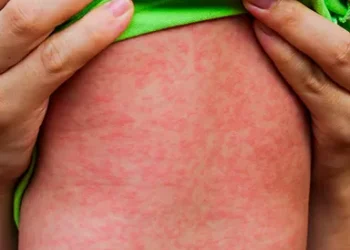 São Paulo confirma primeiro caso de sarampo em 2025